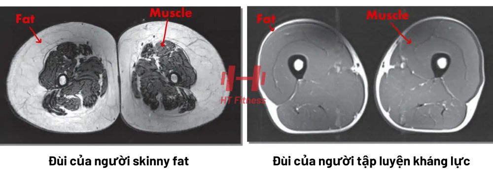 hình ảnh chụp cộng hưởng từ MRI cơ đùi của người skinny fat và người tập luyện kháng lực