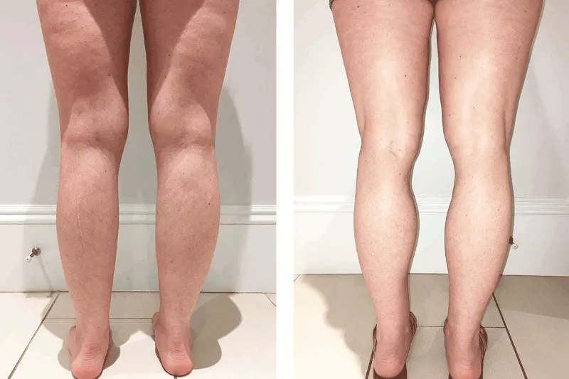 bài tập giảm mỡ bắp chân