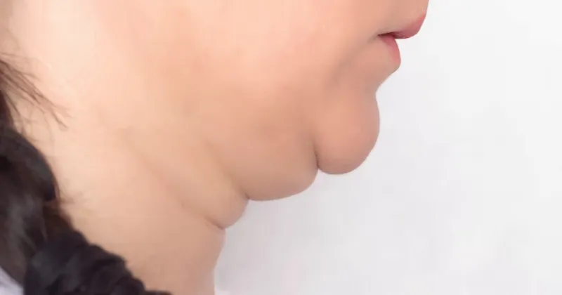 giảm mỡ nọng cằm